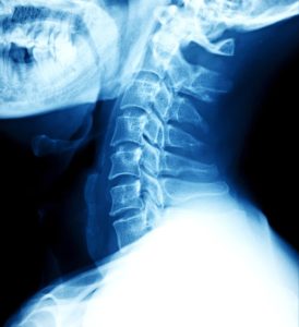 Workers Comp for Neck Injury Omaha NE