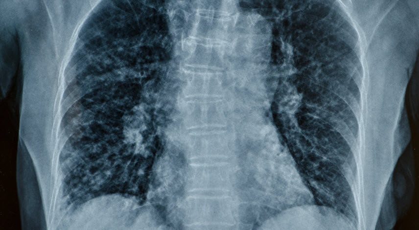 Spinal Cord Injury from an Omaha Car Accident