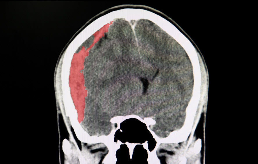 Brain Injuries from a Work Accident