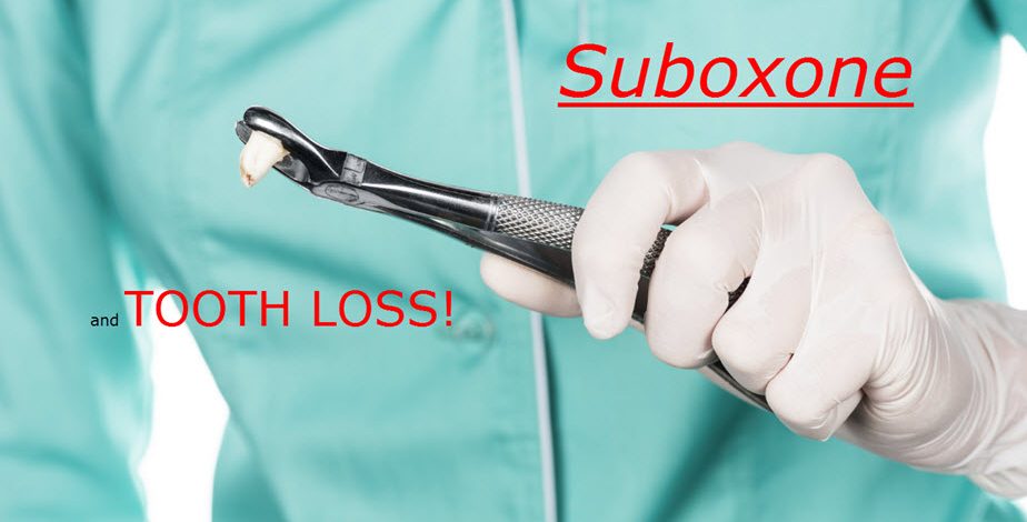 Tooth Loss from Suboxone Strips