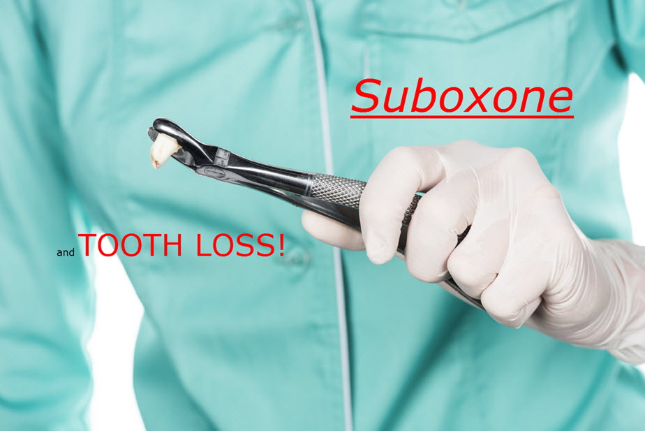 Tooth Loss from Suboxone Strips